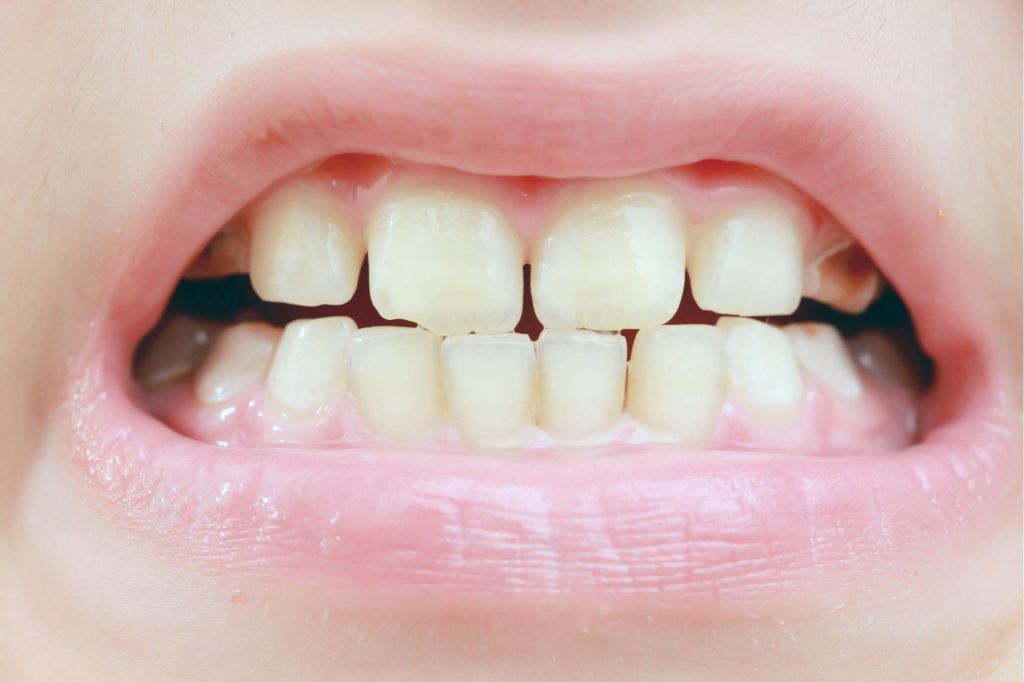 هل يصلح برد الاسنان بعد التقويم في كل الحالات حسب الحاجة؟