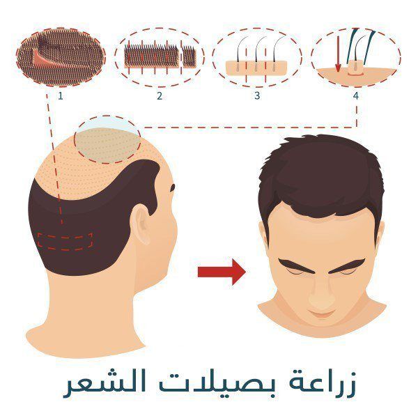 تجربة شخصية لعملية زراعة الشعر