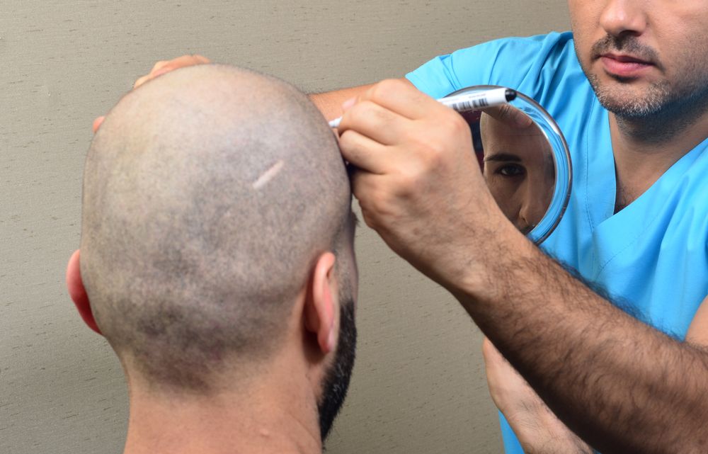  الأشخاص المرشحين لزراعة الشعر الايطالي في السعودية