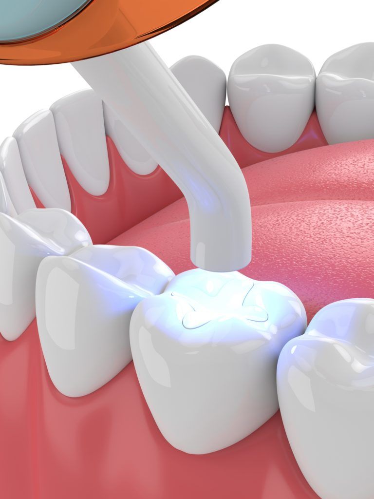 الفرق بين الحشوات الضوئية للأسنان والحشوات التقليدية 