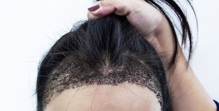زراعة شعر مقدمة الرأس للنساء