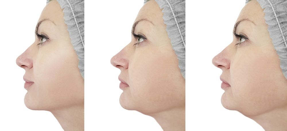 كيفية إجراء عملية شفط دهون الوجه