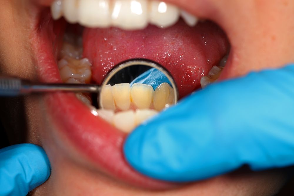 ما هي أبرز أضرار تنظيف الاسنان من الجير؟