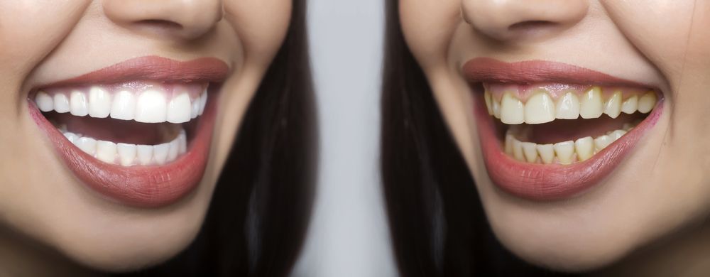 نتائج علاج الابتسامة اللثوية قبل وبعد الفيلر