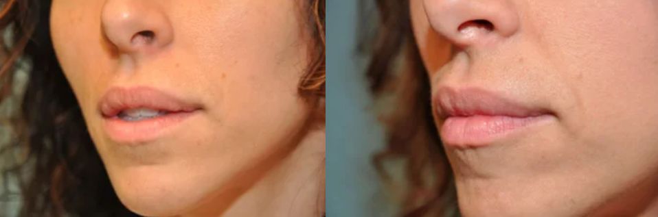 نتيجة عملية تصغير الفم قبل وبعد بالصور 2