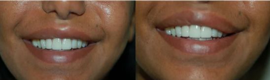نتيجة عملية تصغير الفم قبل وبعد بالصور