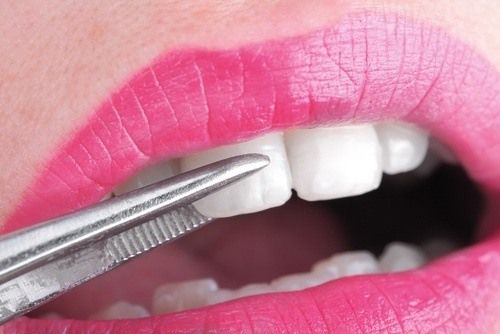 نصائح ذهبية للحفاظ على أسنانك من التسوس