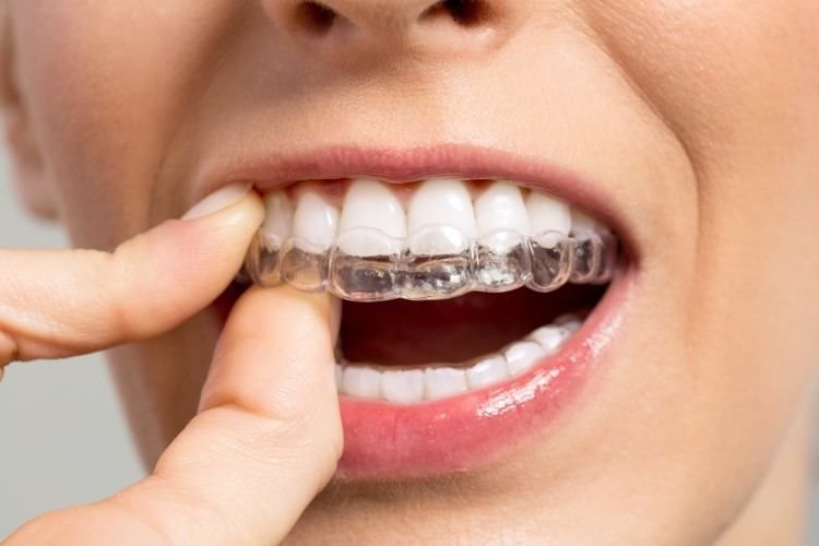هل التقويم الشفاف يعالج بروز الأسنان؟