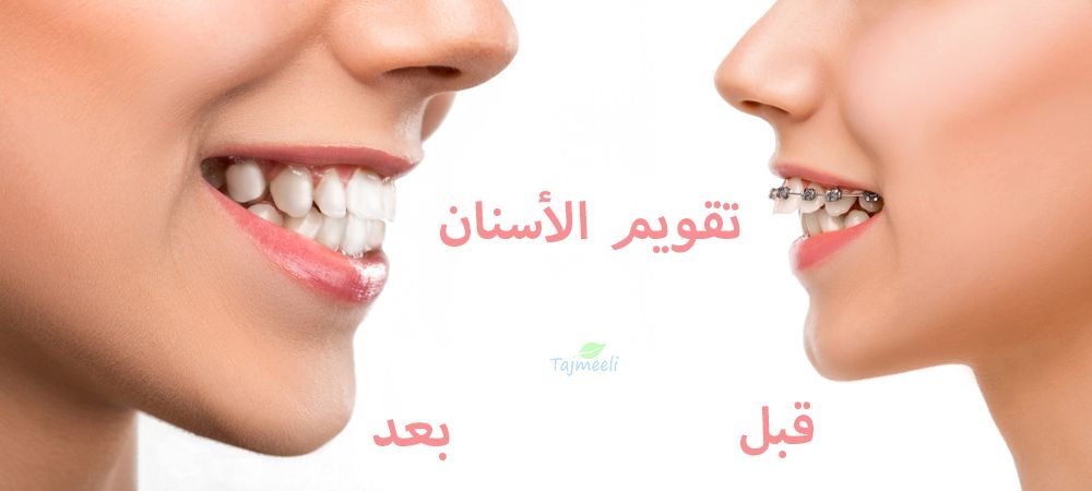 هل عملية تركيب تقويم الأسنان مناسبة للبالغين؟