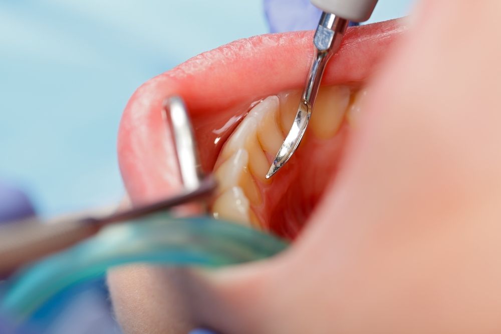 هل يوجد أضرار لتراكم جير الأسنان