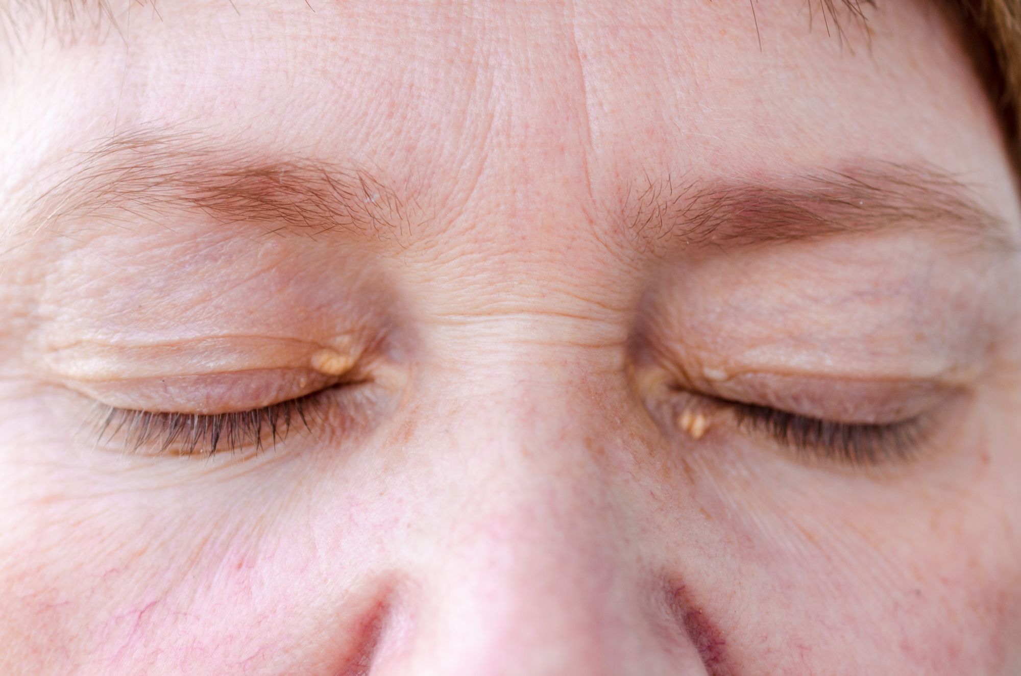 ازالة الزوائد الجلدية حول العين.