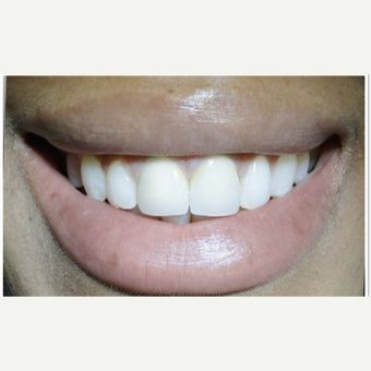 تجربة علاج مشكلة قصر الأسنان الأمامية ٢
