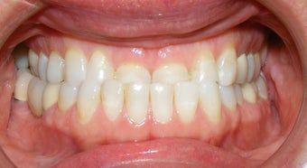 تجربة قص اللثة بعد تقويم الأسنان ١