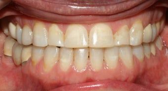 تجربة قص اللثة بعد تقويم الأسنان ٢