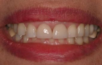 تحسين طول العمودي للأسنان الأمامية ١