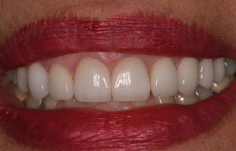 تحسين طول العمودي للأسنان الأمامية ٢