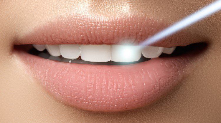 تقنية الليزر لتلميع الاسنان