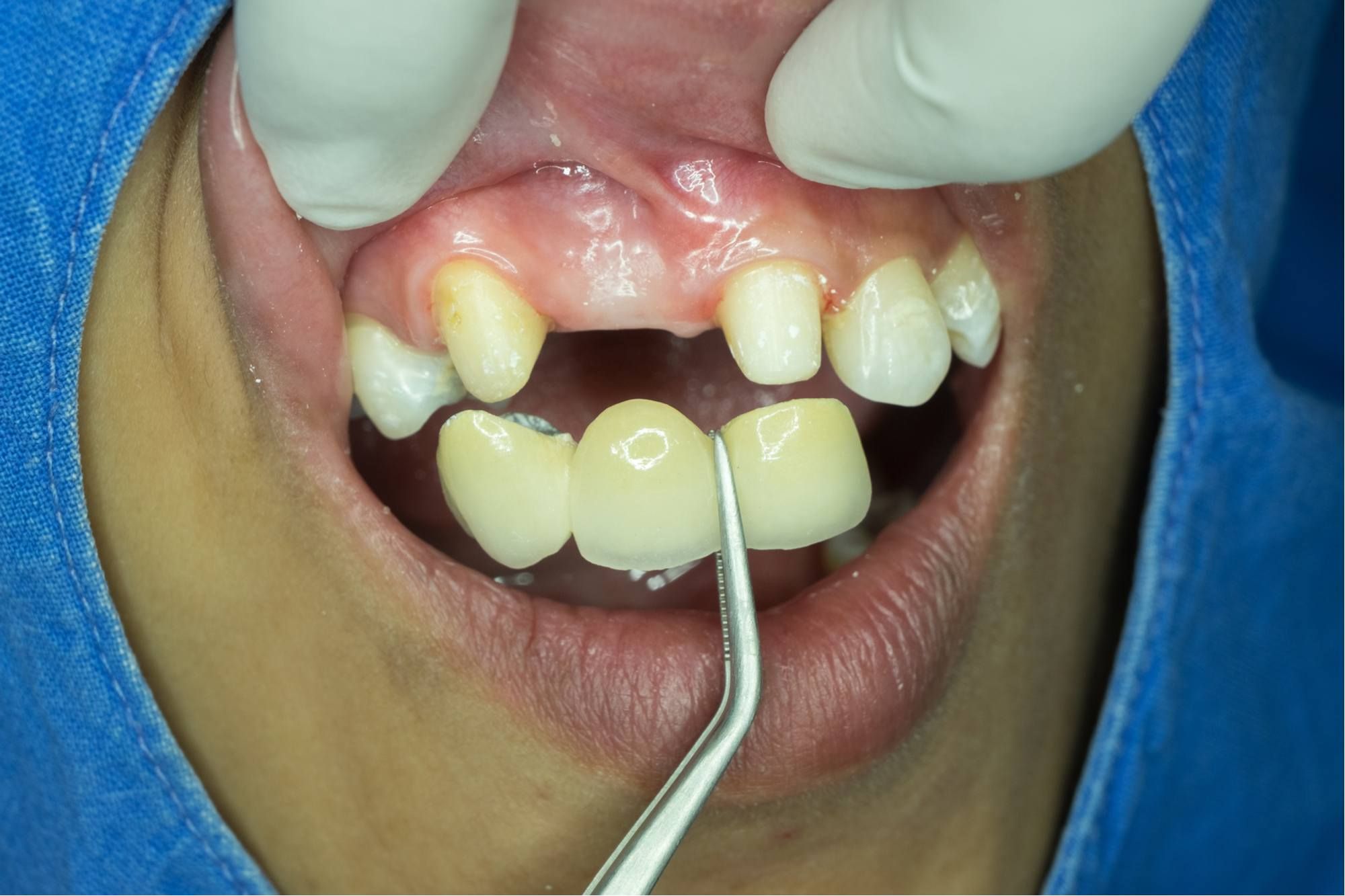 علاج للاسنان المفقودة