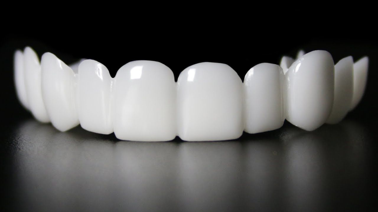 ما هو فينير الأسنان؟