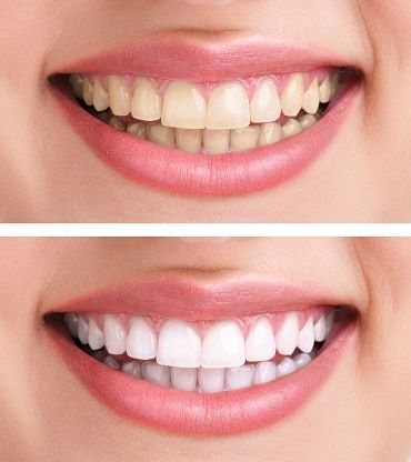 مميزات وعيوب عمليات تجميل الأسنان بالسعودية