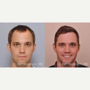 نتائج زراعة الشعر بالصور الحقيقية