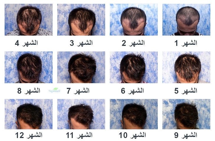 متى تظهر نتيجة عملية زراعة الشعر