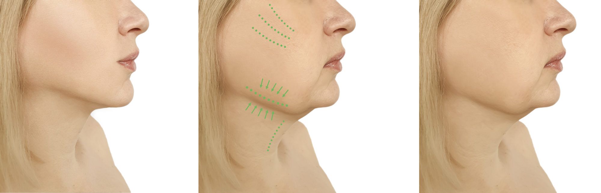 ⁨إزالة الذقن المزدوج⁩ من فوائد شفط دهون الوجه