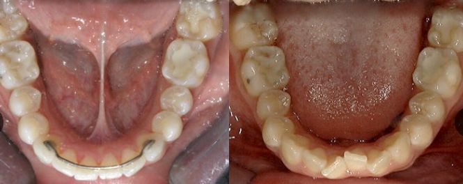⁨‎⁨تجربة علاج فطريات الفم واللثة مع وجود طقم الأسنان⁩⁩