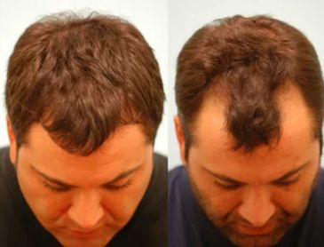 نصائح ما بعد عملية زراعة الشعر