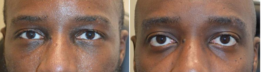 نتائج مرضية بعد اجراء عملية العيون الجاحظة