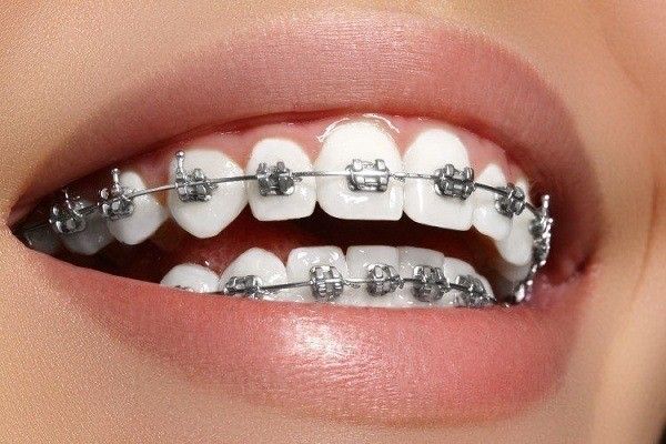 أشهر أنواع تقويم الاسنان الثابت في مصر