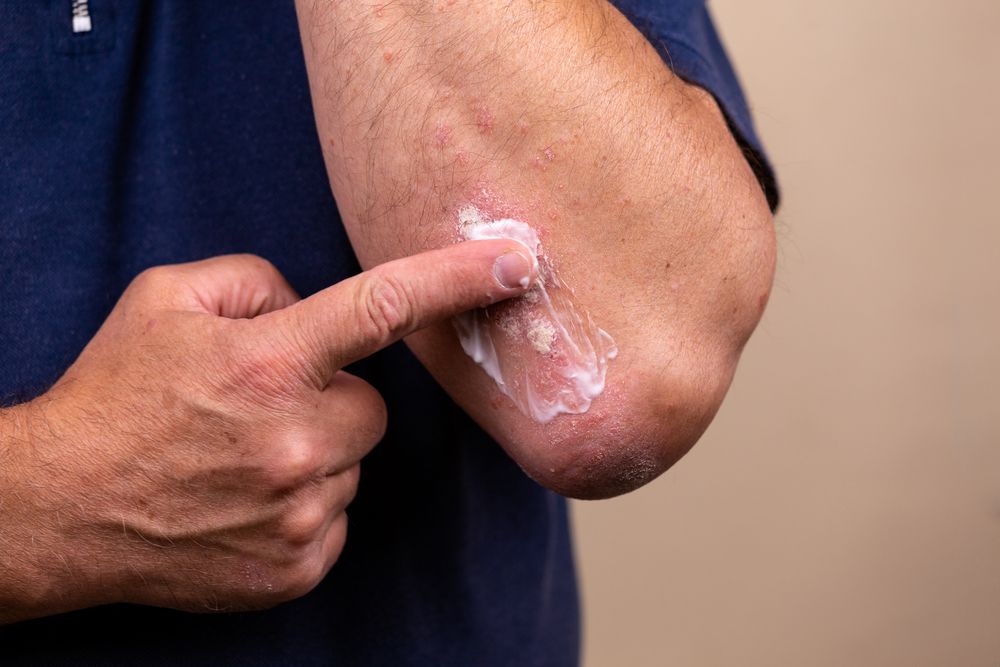 الاكزيما كواحدة من أشهر الأمراض التي تصيب الجلد وعلاجها