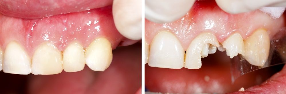 الكسر من اضرار فينير الاسنان