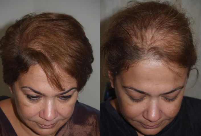 تجربة علاج الصلع عن طريق زراعة الشعر
