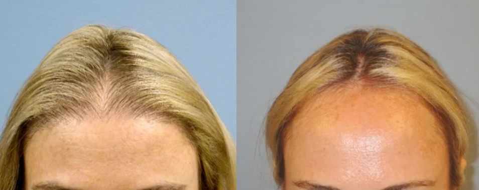 تجربة علاج تساقط الشعر بجلسات الميكرونيدلنج -Microneedling