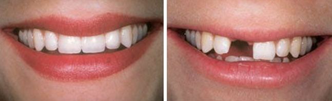 تركيبات الزيركون للأسنان الأمامية 