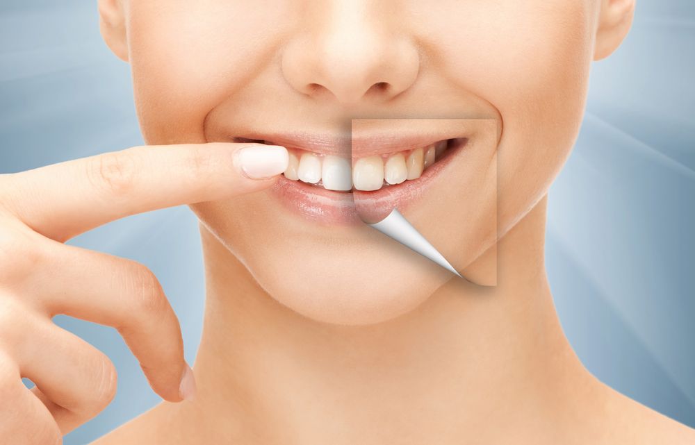 تقنيات تلميع الأسنان