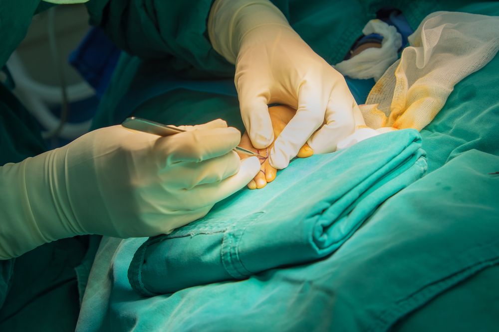 خطوات فصل الأصابع الملتحمة جراحياً وبعض الملاحظات الخاصة بالجراحة