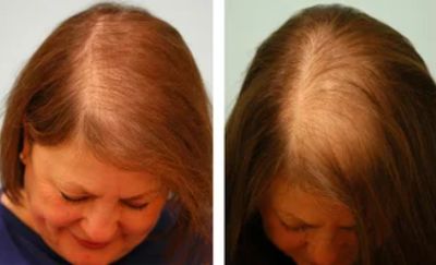 زراعة الشعر بتقنية البيوفايبر لعلاج تساقط الشعر