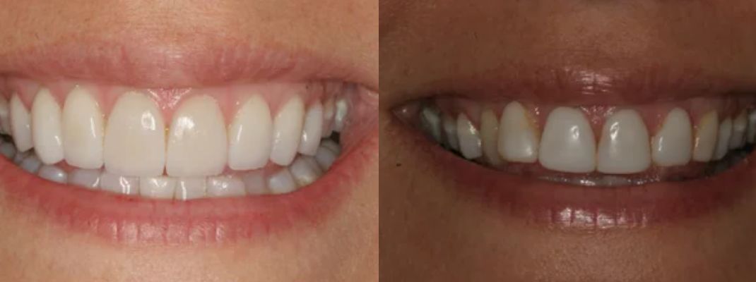 صور تنظيف وتلميع الأسنان قبل وبعد 