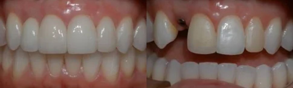صور قبل وبعد تركيب الأسنان الزيركون2
