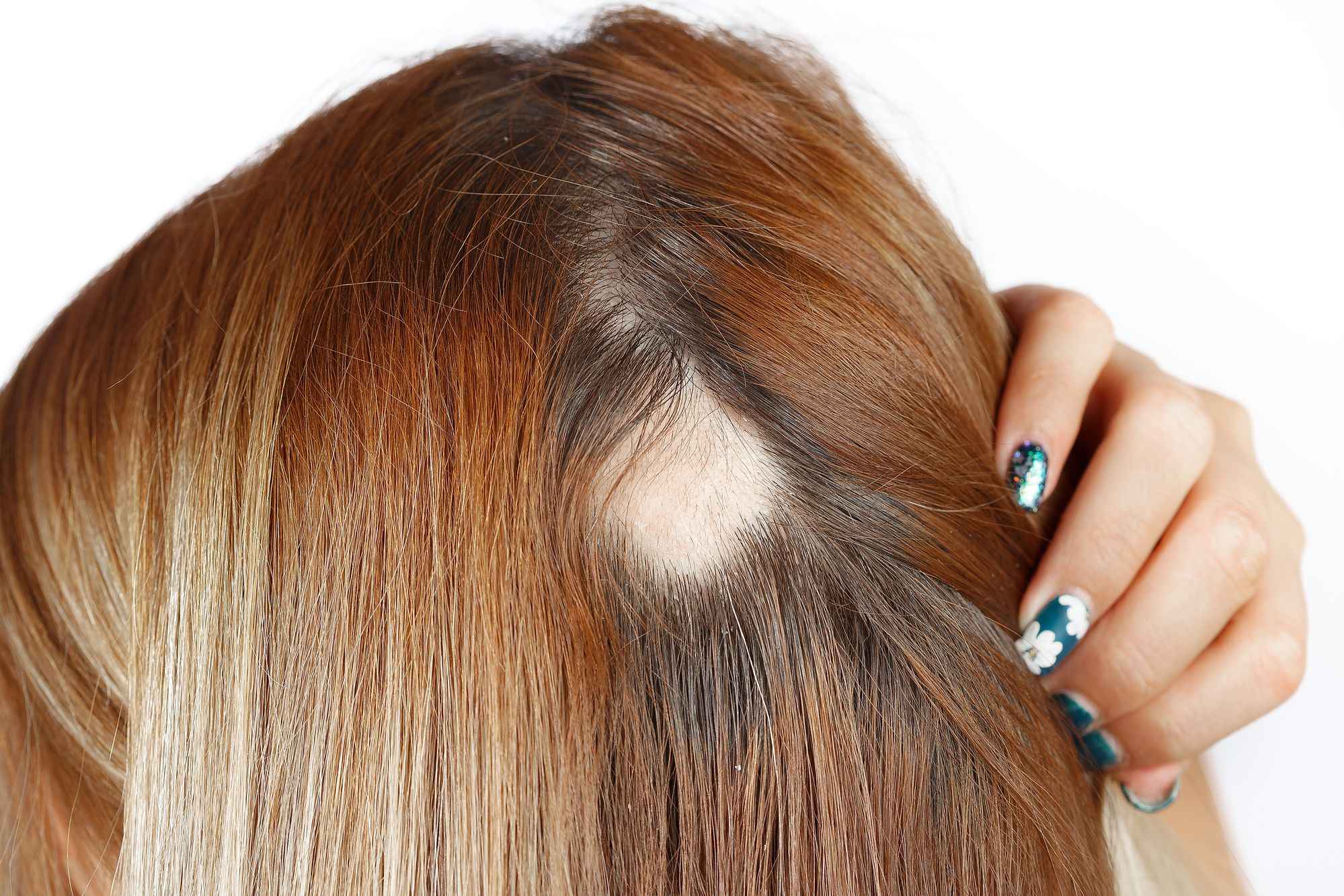 ⁨‎⁨علاج الثعلبة من مميزات الخلايا الجذعية لعلاج الشعر ⁩⁩