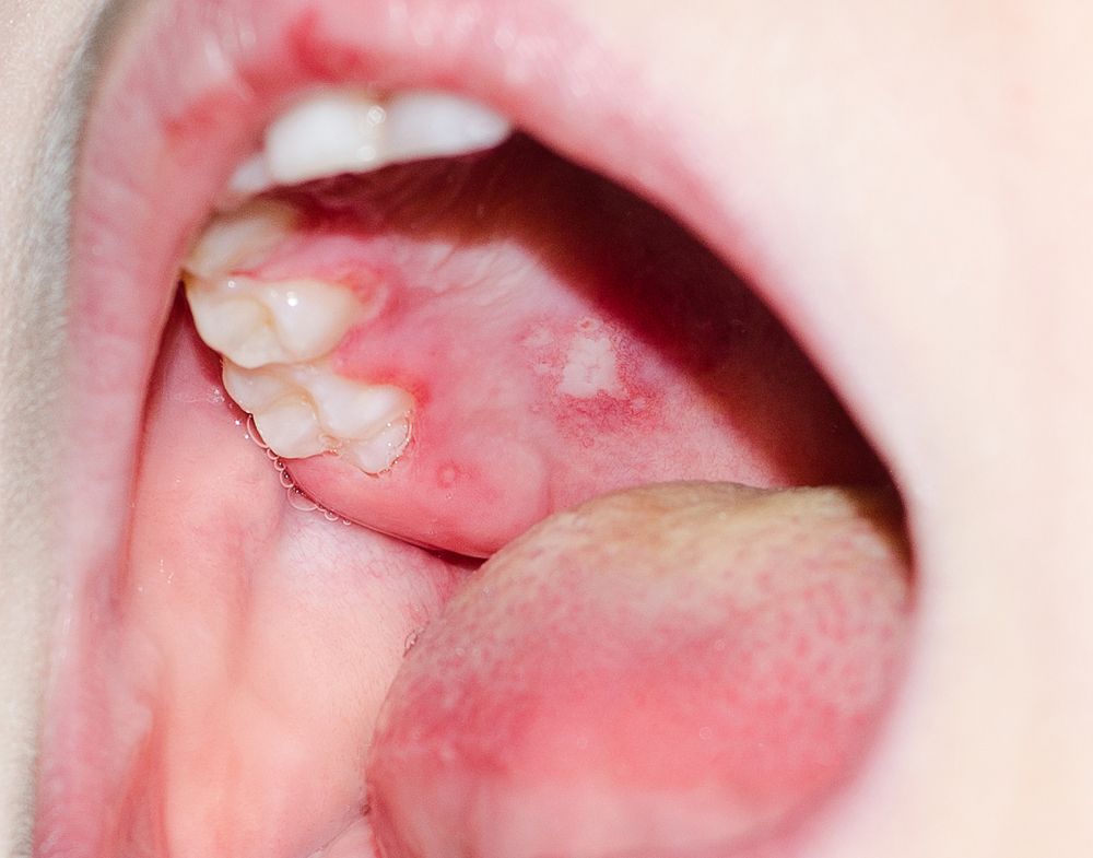 علاج الفطريات في اللثة والفم 