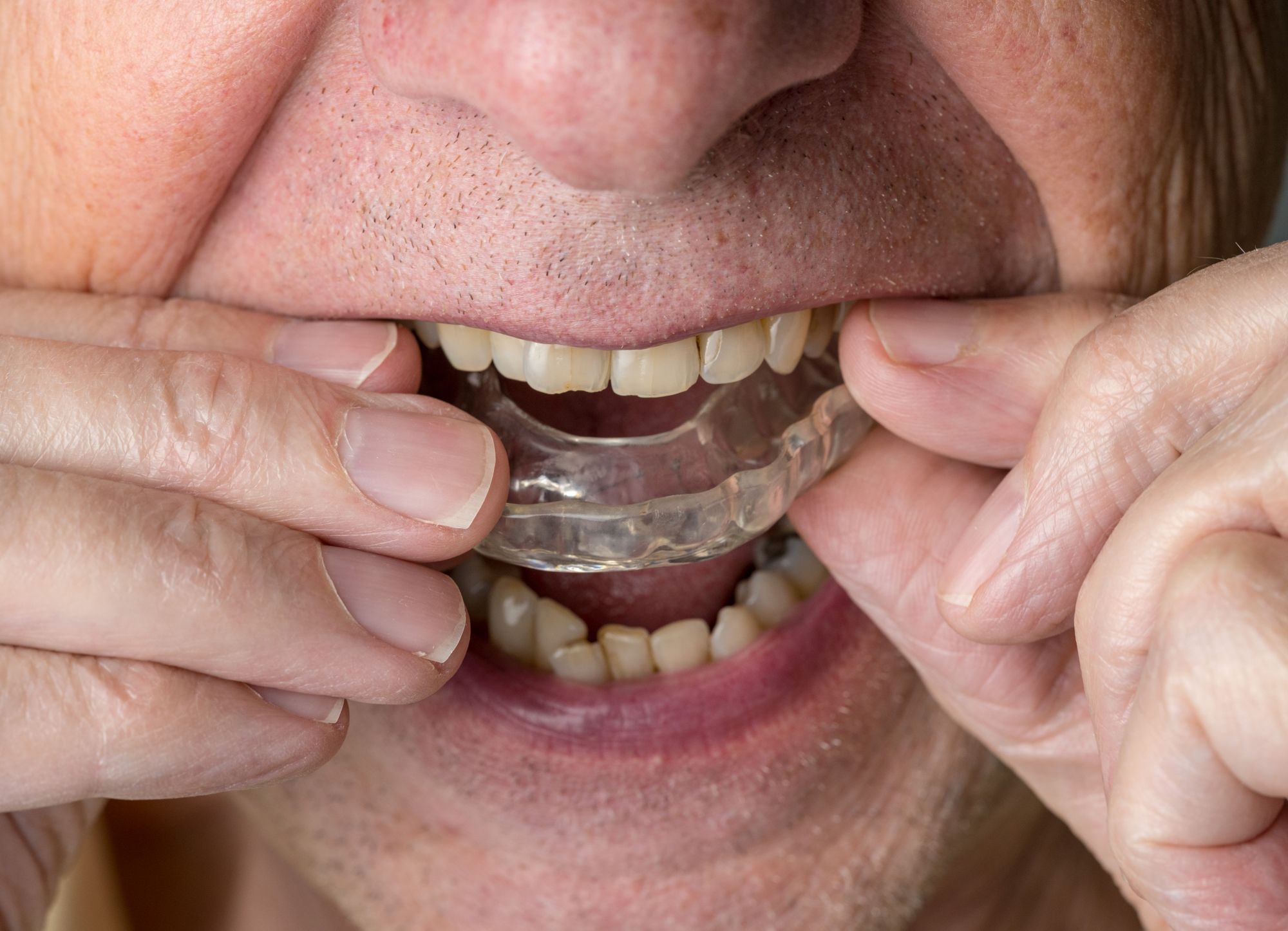 ‎⁨علاج لمشاكل الاسنان بتقويم الاسنان الشفاف المتحرك⁩