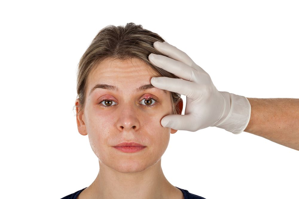 ⁨‎⁨عملية ازالة الأكياس الدهنية تحت العين⁩⁩