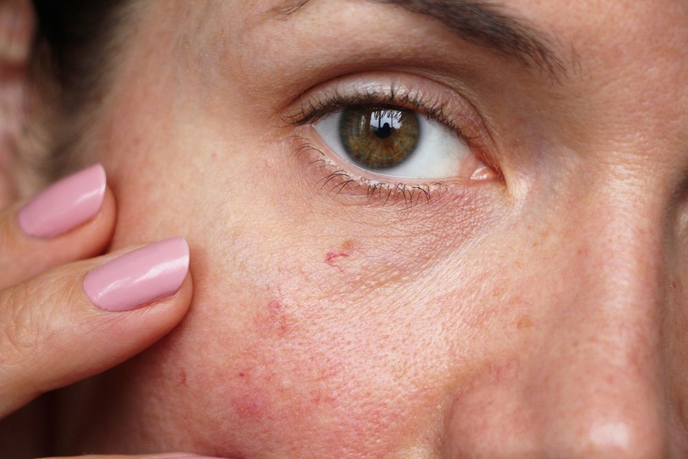 قد يعاني البعض من حساسية الجلد نتيجة استخدام زيت اللو