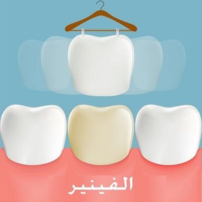 نبذة عن فينير الأسنان في مدينة الرياض