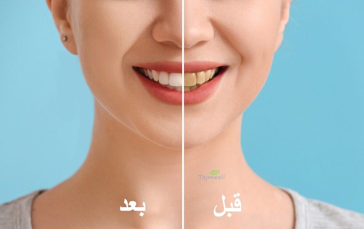 نتائج تلميع الأسنان قبل وبعد