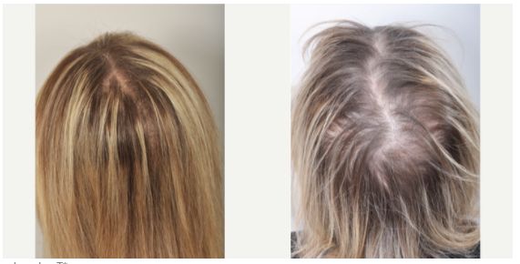 نتائج وتجارب استخدام شامبو الشعر من GK بعد البروتين
