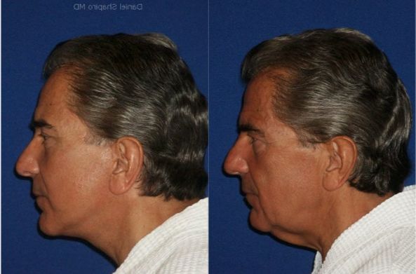 ⁨صور عملية شد الوجه جراحياً قبل وبعد ٣